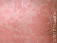 Tinea Versicolor