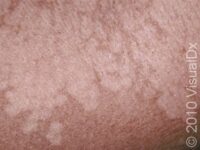 Tinea Versicolor