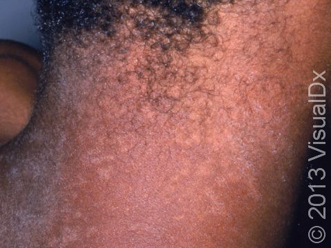 Tinea versicolor extends from the trunk to the neck in this young man.