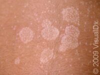 Tinea Versicolor