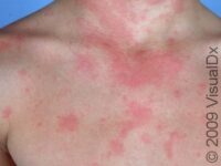 Hives (Urticaria)