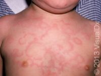 Hives (Urticaria)