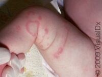 Hives (Urticaria)
