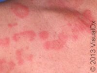 Hives (Urticaria)