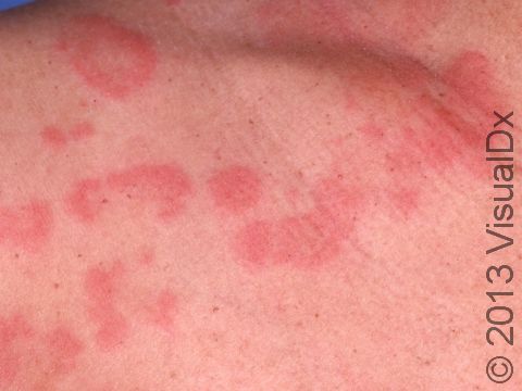 This image displays round, pink areas with clear zones common to urticaria (hives).