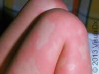 Hives (Urticaria)