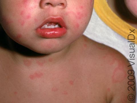 This image displays widespread urticaria (hives) involving the face.