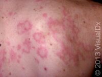 Hives (Urticaria) – Adult