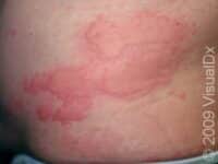 Hives (Urticaria)