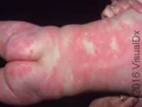 Hives (Urticaria)