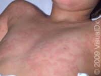 Hives (Urticaria)
