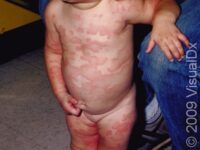Hives (Urticaria)