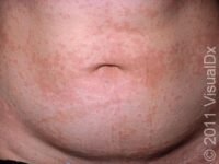 Hives (Urticaria)