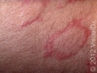 Hives (Urticaria)