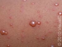 Chickenpox (Varicella)