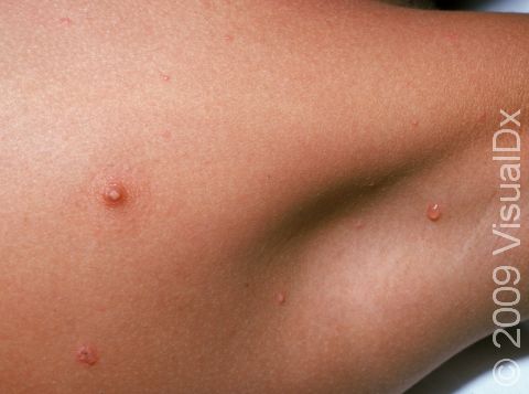 In this chickenpox (varicella) image, there are 3 small blisters in and around the armpit.