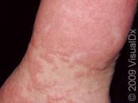 Viral Exanthem – Adult