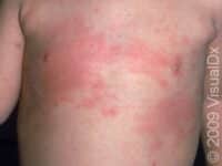 Viral Exanthem