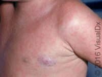 Viral Exanthem