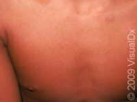 Viral Exanthem