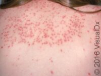 Viral Exanthem