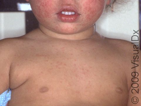 Fifth disease causes a rash on the cheeks and a more widespread rash that typically involves the trunk and arms.