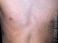 Viral Exanthem