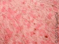 Viral Exanthem