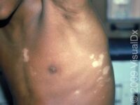 Vitiligo