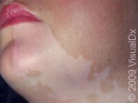 Vitiligo