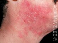 Managing Moderate-to-Severe Eczema: Update on Treatments