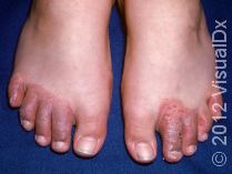 Contact Dermatitis Pediatric