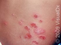 Impetigo, Non-Bullous