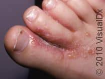 Irritant Contact Dermatitis