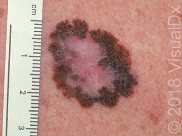 melanoma-ABCDE.jpg?mtime=20180628150046#asset:274805