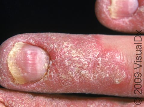 Psoriasis involving the fingernails may cause an irregular nail plate as well as separation of the nail from the nail bed (onycholysis). This individual also has psoriasis of the skin around the nail.