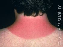 sunburn_44610_med.jpg