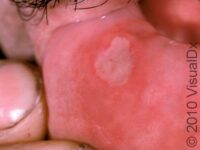 Canker Sore (Aphthous Ulcer)