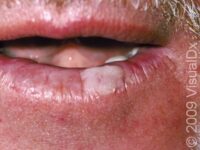 Common Wart