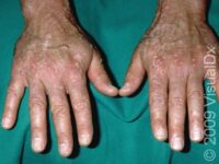 Flat Wart