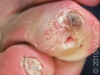 Diabetic Ulcer (Neurogenic Ulcer)
