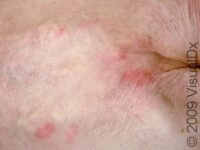 Bedsores (Pressure Ulcers)