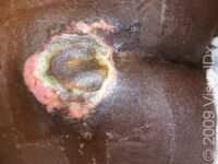 Bedsores (Pressure Ulcers)