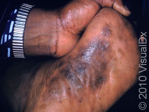 This image displays the skin darkening that accompanies a rash on people with darker skin, in this case, tinea pedis (athlete's foot).