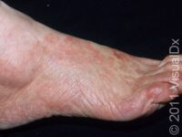 Athlete’s Foot (Tinea Pedis)