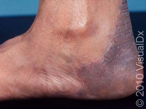 As displayed in this image, tinea pedis (athlete's foot) often has a sharp border.