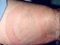 Hives (Urticaria)