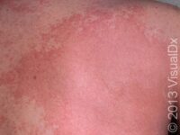 Hives (Urticaria)