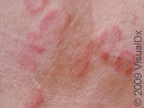 Urticaria (hives) often forms rings, and ring-like shapes.