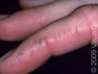 Dry Skin (Xerosis)